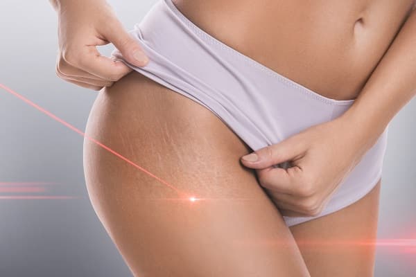 Stretch marks during laser removal session treatment