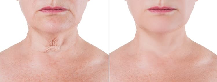 Skin rejuvenation on the neck, before after anti aging concept, wrinkle treatment, facelift and plastic surgery