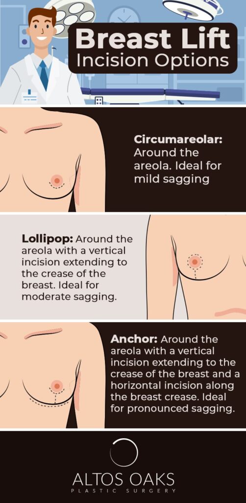 Breast-Lift-Incision-Options